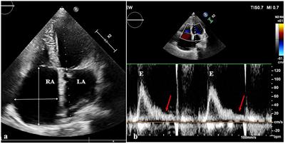 Left Bundle Branch Area Pacing in a Giant Atrium With Atrial Standstill: A Case Report and Literature Review